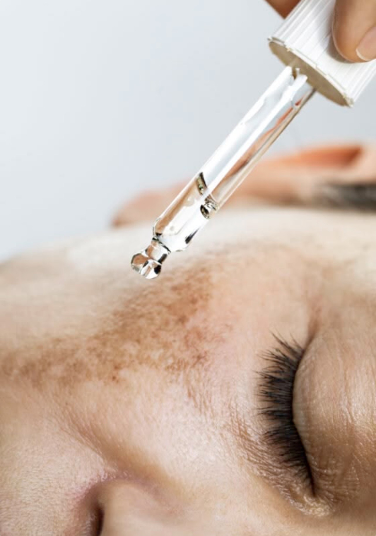 Tratamento para Melasma — imagem 2